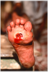 The damage to the foot.
